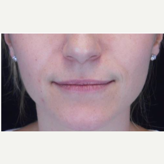 Juvederm to the lips before 3283672