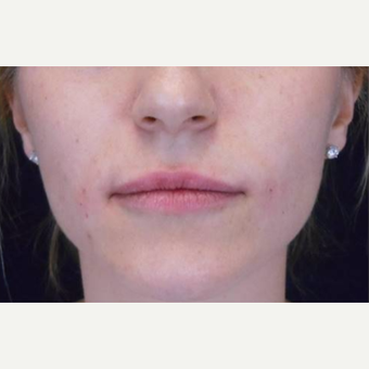 Juvederm to the lips after 3283672