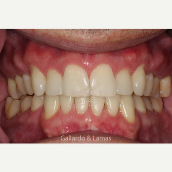 25-34 year old male treated with Gum Lift after 3075178