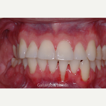 25-34 year old male treated with Gum Lift before 3075178
