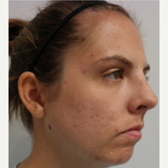 25-34 year old woman treated with Infini RF for acne and acne scars after 3059670