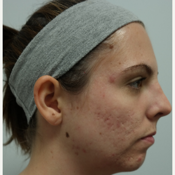 25-34 year old woman treated with Infini RF for acne and acne scars before 3059670
