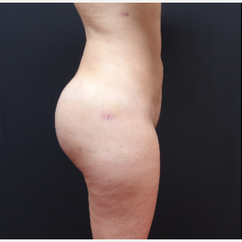 25-34 year old woman treated with Butt Augmentation after 3629864