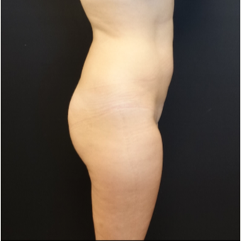 25-34 year old woman treated with Butt Augmentation before 3629864