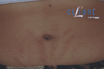 Laser Stretch Mark Removal, Before and After Pictures after 1375587