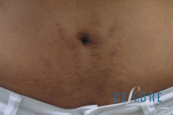 Laser Stretch Mark Removal, Before and After Pictures before 1375587