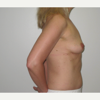 45-54 year old woman treated with Breast Implants before 3666126