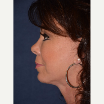 45-54 year old woman treated with Facelift after 3466580