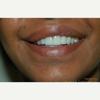 35-44 year old woman treated with Lip Reduction before 2444222
