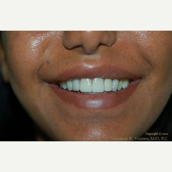 35-44 year old woman treated with Lip Reduction after 2444222