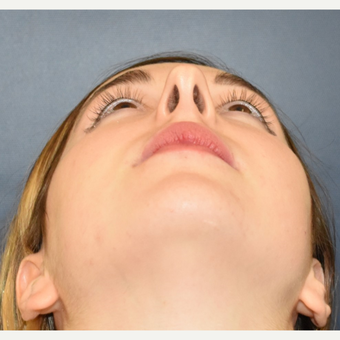 18-24 year old woman treated with Rhinoplasty before 3503441