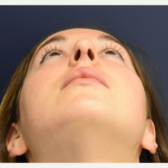 18-24 year old woman treated with Rhinoplasty after 3503441