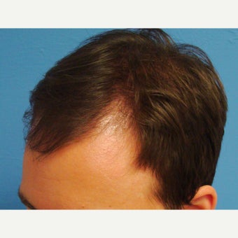 35-44 year old man treated with FUE Hair Transplant before 1760216