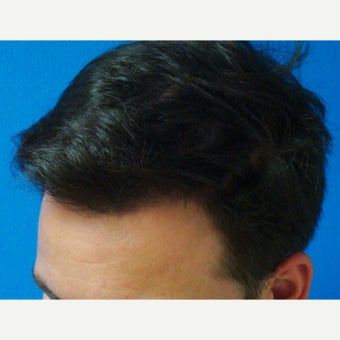 35-44 year old man treated with FUE Hair Transplant after 1760216