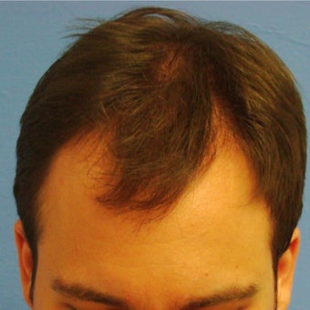 35-44 year old man treated with FUE Hair Transplant 1760216