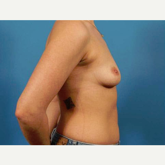 25-34 year old woman treated with Breast Implants before 3787041