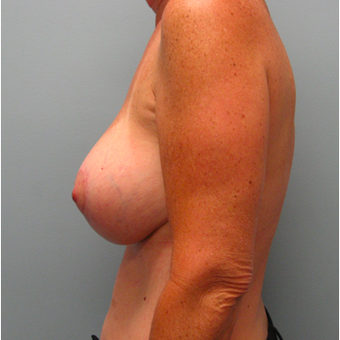 53 year old woman treated with Breast Lift with Implants after 3468111