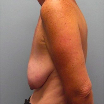 53 year old woman treated with Breast Lift with Implants before 3468111