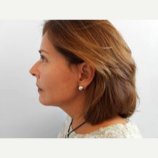 55-64 year old woman treated with Facelift after 3500866