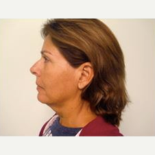 55-64 year old woman treated with Facelift before 3500866