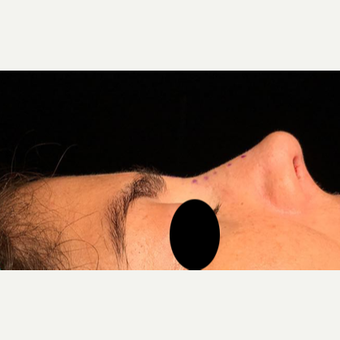 25-34 year old woman treated with Rhinoplasty after 3211278