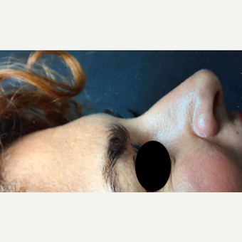 25-34 year old woman treated with Rhinoplasty before 3211278