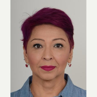 45-54 year old woman treated with Injectable Filler, Teosyal after 2561054