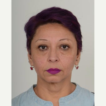 45-54 year old woman treated with Injectable Filler, Teosyal before 2561054