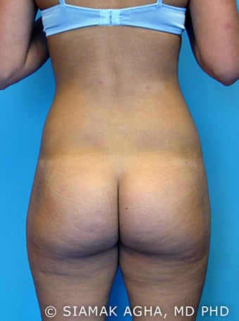 Brazilian Butt Lift after 216764