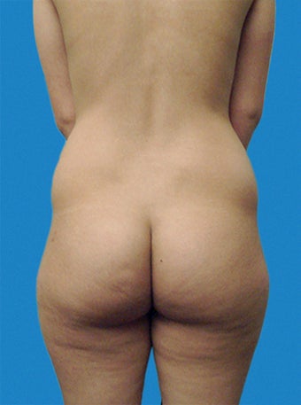 Brazilian Butt Lift before 216764