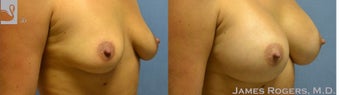 25-34 year old woman treated with a Breast Augmentation 2051348