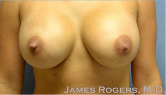 25-34 year old woman treated with a Breast Augmentation after 2051348
