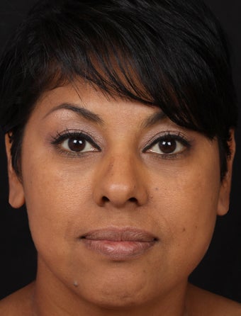 Filler for Under-Eye Hollows after 1350545
