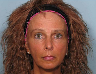 Sculptra after 460617