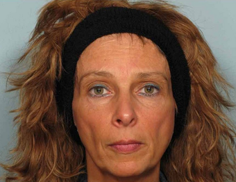 Sculptra before 460617