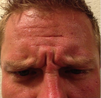 Young Male Treated for Forehead and Glabellar Wrinkles before 1367262