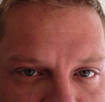 Young Male Treated for Forehead and Glabellar Wrinkles after 1367262