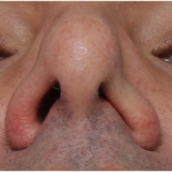 35-44 year old man treated with Rhinoplasty before 3544955