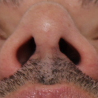 35-44 year old man treated with Rhinoplasty after 3544955