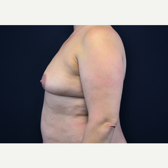 35-44 year old woman treated with Breast Implants before 3441091