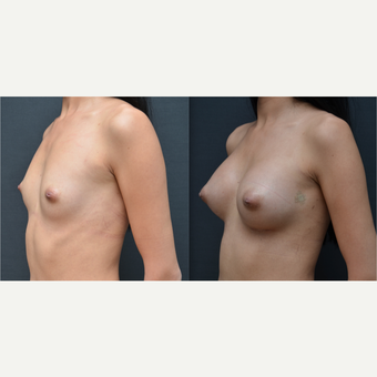18-24 year old woman treated with Breast Augmentation before 3238732