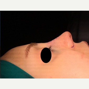 25-34 year old woman treated with Rhinoplasty after 3211800