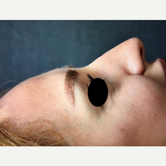 25-34 year old woman treated with Rhinoplasty before 3211800