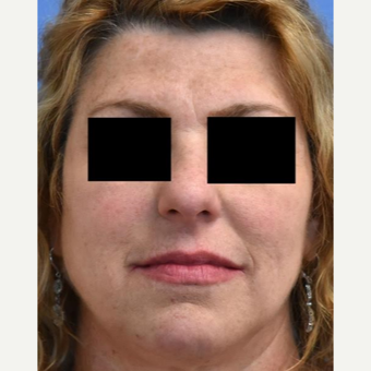 45-54 year old woman treated with Skin Rejuvenation before 3036854