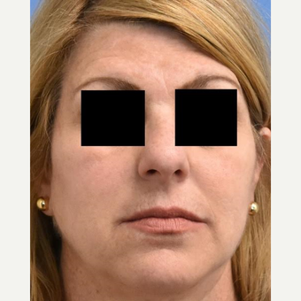 45-54 year old woman treated with Skin Rejuvenation after 3036854