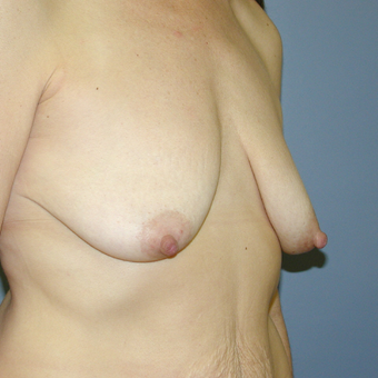 47 year old woman treated with Breast Lift before 3042744