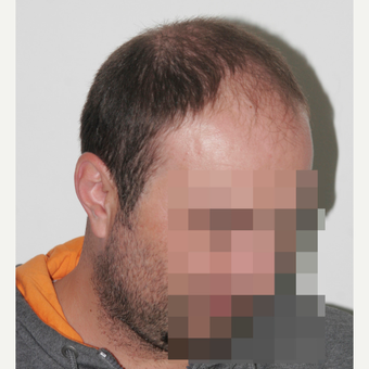 33 years old man treated with FUE Hair Transplant before 3068910