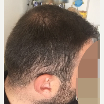33 years old man treated with FUE Hair Transplant after 3068910