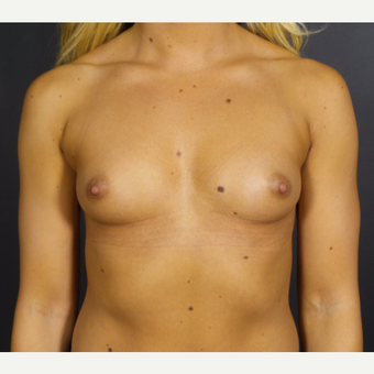 25-34 year old woman treated with Breast Implants before 3585659