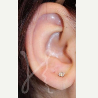 25-34 year old woman treated with Ear Lobe Surgery after 1736899
